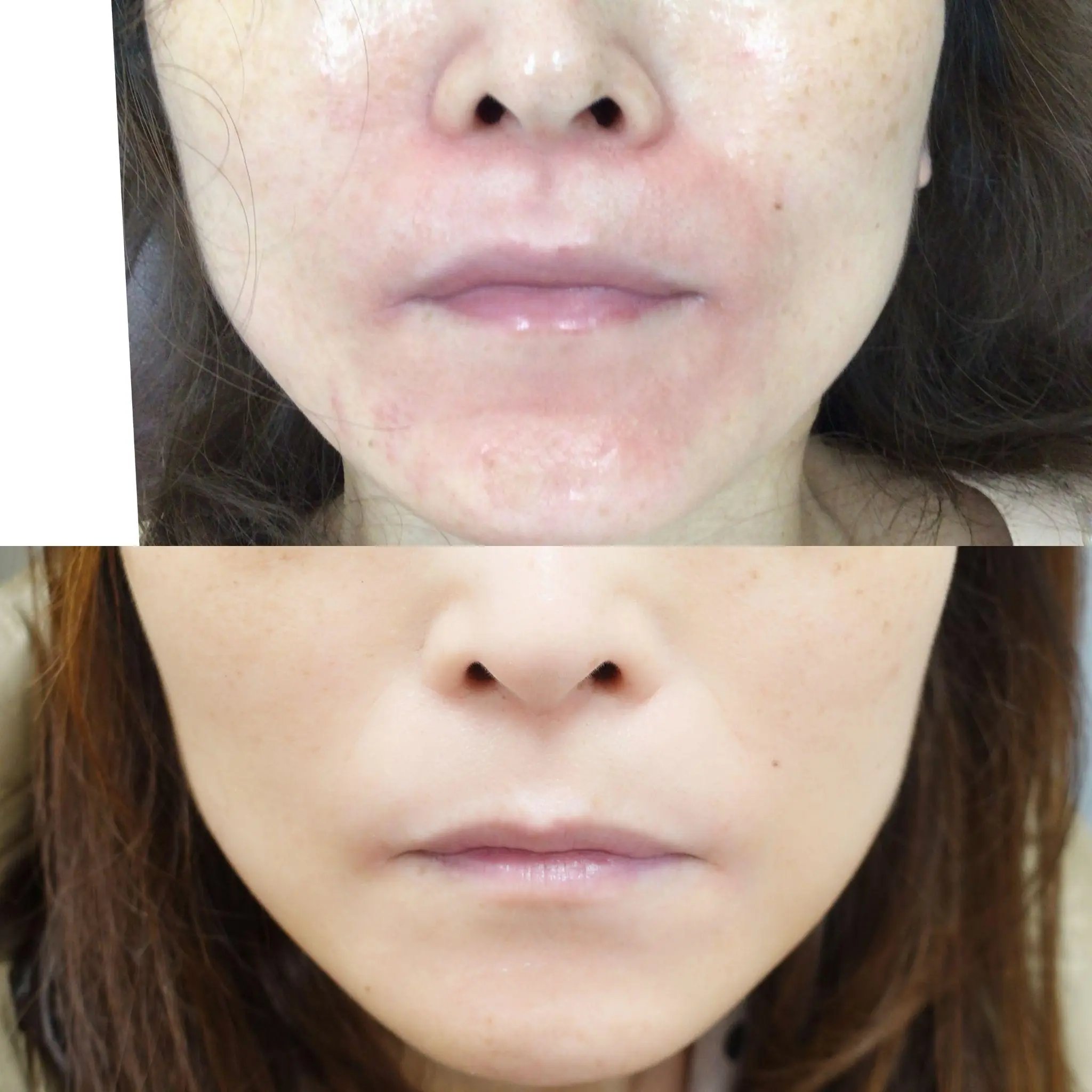 マスクの擦れで口周りが赤くなりやすい